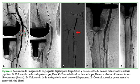 Secuencia de imágenes de angiografía digital para diagnóstico y tratamiento. A. Lesión oclusiva de la arteria poplítea. B. Colocación de la endoprótesis poplítea. C. Permeabilidad en la arteria poplítea con obstrucción en el tronco tibioperoneo (flecha). D. Colocación de la endoprótesis en el tronco tibioperoneo. E. Control posterior que muestra la permeabilidad distal.