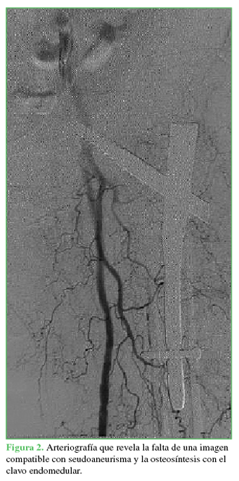 Arteriografía que revela la falta de una imagen compatible con seudoaneurisma y la osteosíntesis con el clavo endomedular.