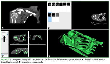 A. Imagen de tomograf&iacute;a computarizada. B. Selecci&oacute;n de ventana de partes blandas. C. Selecci&oacute;n de estructuras &oacute;seas (flecha negra). D. Estructuras seleccionadas.