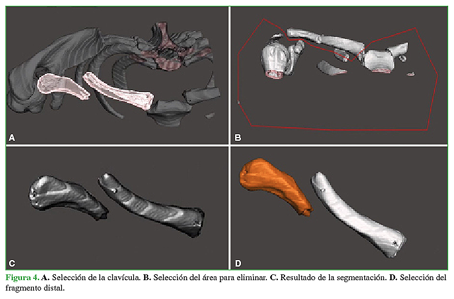 A. Selecci&oacute;n de la clav&iacute;cula. B. Selecci&oacute;n del &aacute;rea para eliminar. C. Resultado de la segmentaci&oacute;n. D. Selecci&oacute;n del fragmento distal.