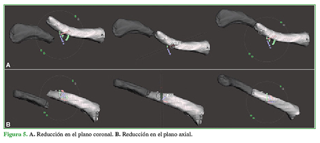 A. Reducci&oacute;n en el plano coronal. B. Reducci&oacute;n en el plano axial. 