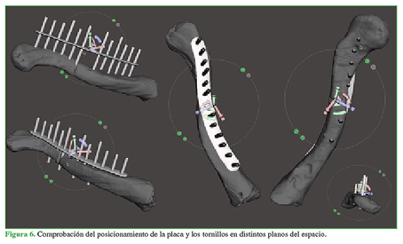 Comprobaci&oacute;n del posicionamiento de la placa y los tornillos en distintos planos del espacio.