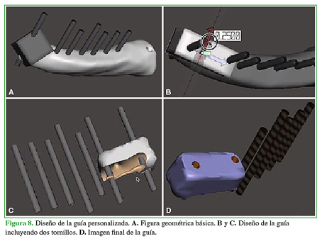 Dise&ntilde;o de la gu&iacute;a personalizada. A. Figura geom&eacute;trica b&aacute;sica. B. y C. Dise&ntilde;o de la gu&iacute;a incluyendo dos tornillos. D. Imagen final de la gu&iacute;a.