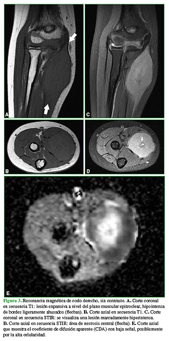 Resonancia magnética de codo derecho, sin contraste. A. Corte coronal en secuencia T1: lesión expansiva a nivel del plano muscular epitroclear, hipointensa de bordes ligeramente ahusados (flechas). B. Corte axial en secuencia T1. C. Corte coronal en secuencia STIR: se visualiza una lesión marcadamente hiperintensa. D. Corte axial en secuencia STIR: área de necrosis central (flecha). E. Corte axial que muestra el coeficiente de difusión aparente (CDA) con baja señal, posiblemente por la alta celularidad. 