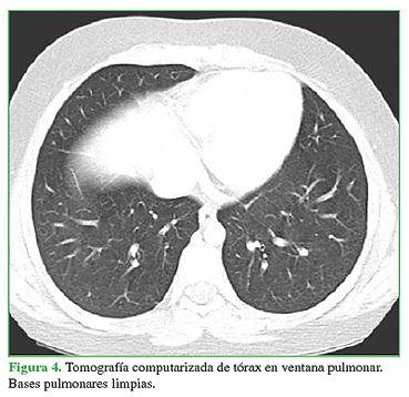 Tomografía computarizada de tórax en ventana pulmonar. Bases pulmonares limpias.