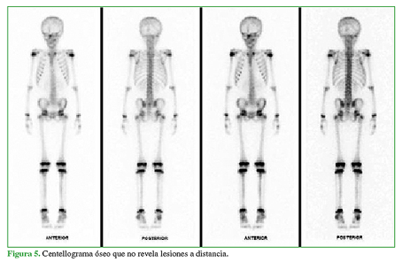 Cenetellograma óseo que no revela lesiones a distancia.