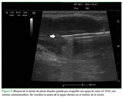 Biopsia de la lesión de partes blandas guiada por ecografía con aguja de corte 14-10 G, con sistema semiautomático. Se visualiza la punta de la aguja (flecha) en el interior de la lesión. 