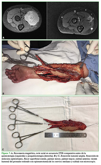 A.  Resonancia magnética, corte axial en secuencia STIR comparativa antes de la quimioterapia (izquierda) y posquimioterapia (derecha). B. y C. Resección tumoral amplia. Resección de músculos epitrocleares, flexor superficial común, palmar menor, palmar mayor, cubital anterior, vientre humeral del pronador redondo con epineurectomía de los nervios mediano y cubital con microscopio.