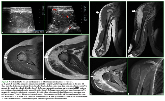 Paciente de 10 años con tumoración dolorosa en el hombro derecho de un mes de evolución. A. Ecografía de partes blandas que muestra una tumoración hipoecogénica, de bordes poco definidos, en el interior del plano muscular. B. Escasa vascularización en el estudio Doppler. C. Resonancia magnética, corte coronal en secuencia T1: aumento del tamaño del músculo deltoides (flecha). D. Resonancia magnética, corte coronal en secuencia STIR: lesión de aspecto difuso e importante edema del resto del deltoides (flecha). E. Resonancia magnética, corte axial en secuencia T1: aumento del tamaño del deltoides sin compromiso del tejido celular subcutáneo (flecha). F. Resonancia magnética, corte axial en secuencia T2: mejor diferenciación entre la lesión y el edema muscular (flecha). G. Resonancia magnética, corte axial en secuencia STIR: lesión en el interior del deltoides (flecha). H. Radiografía de control a los 60 días del dolor original. Se visualiza una voluminosa calcificación de partes blandas compatible con miositis osificante.  