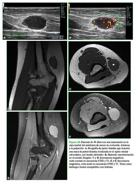 Paciente de 49 años con una tumoración en la cara medial del antebrazo de meses de evolución, dolorosa a la palpación A. Ecografía de partes blandas que muestra una masa de partes blandas localizada en el tejido celular subcutáneo, con bordes definidos. B. Marcada vascularización en el estudio Doppler. C y D. Resonancia magnética, corte coronal en secuencias STIR y T1. E y F. Resonancia magnética, corte axial en secuencias STIR y T1. Todos estos hallazgos fueron compatibles con linfoma.