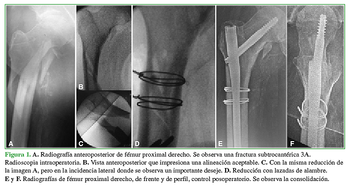 A. Radiografía anteroposterior de fémur proximal derecho. Se observa una fractura subtrocantérica 3A. Radioscopia intraoperatoria. B. Vista anteroposterior que impresiona una alineación aceptable. C. Con la misma reducción de la imagen A, pero en la incidencia lateral donde se observa un importante deseje. D. Reducción con lazadas de alambre. E y F. Radiografías de fémur proximal derecho, de frente y de perfil, control posoperatorio. Se observa la consolidación.