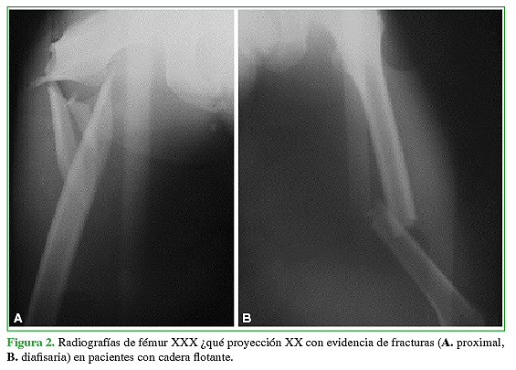 Radiografías de fémur, de frente, con evidencia de fracturas (A. proximal, B. diafisaria) en pacientes con cadera flotante. 