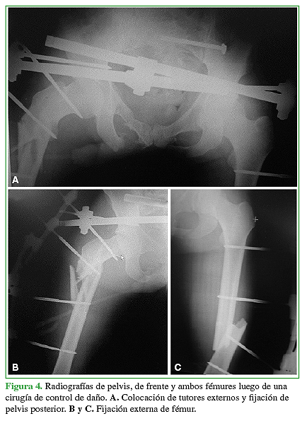 Radiografías de pelvis, de frente y ambos fémures luego de una cirugía de control de daño. A. Colocación de tutores externos y fijación de pelvis posterior. B y C. Fijación externa de fémur.
