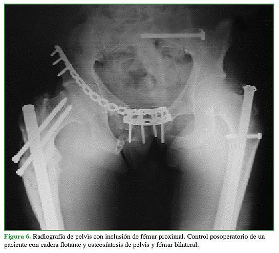 Radiografía de pelvis con inclusión de fémur proximal. Control posoperatorio de un paciente con cadera flotante y osteosíntesis de pelvis y fémur bilateral.