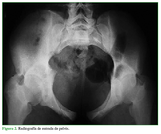 Radiografía de entrada de pelvis.