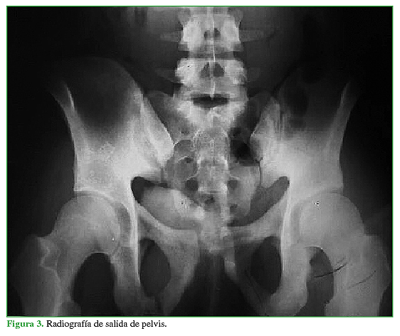 Radiografía de salida de pelvis.