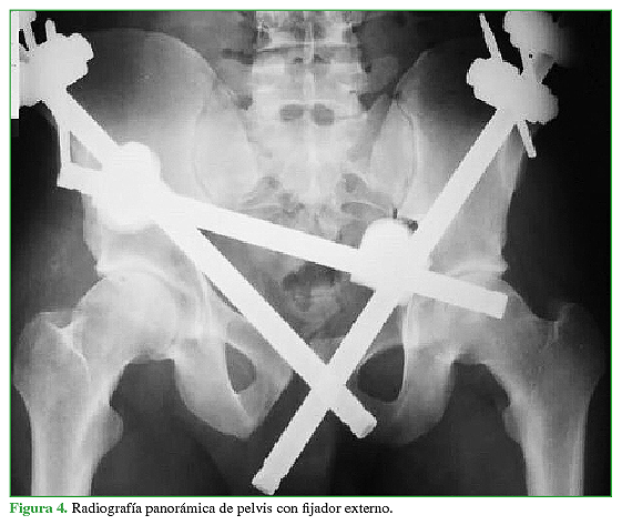 Radiografía panorámica de pelvis con fijador externo.