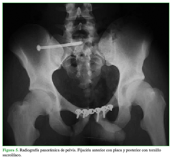 Radiografía panorámica de pelvis. Fijación anterior con placa y posterior con tornillo sacroilíaco.