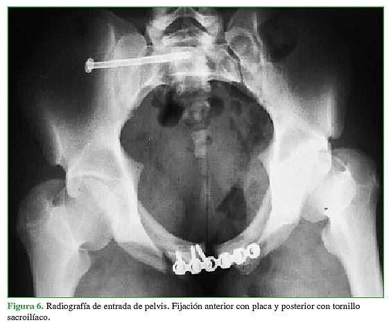 Radiografía de entrada de pelvis. Fijación anterior con placa y posterior con tornillo sacroilíaco.
