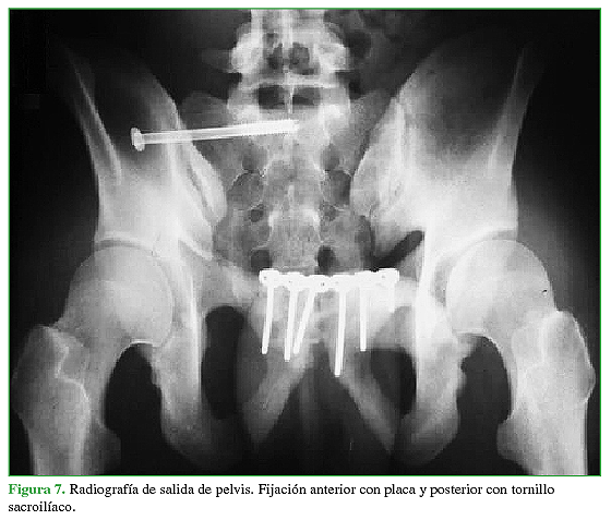 Radiografía de salida de pelvis. Fijación anterior con placa y posterior con tornillo sacroilíaco.