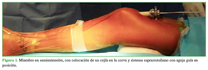 Miembro en semiextensión, con colocación de un cojín en la corva y sistema suprarrotuliano con aguja guía en posición.