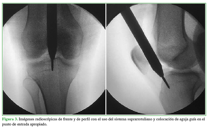 Imágenes radioscópicas de frente y de perfil con el uso del sistema suprarrotuliano y colocación de aguja guía en el punto de entrada apropiado.