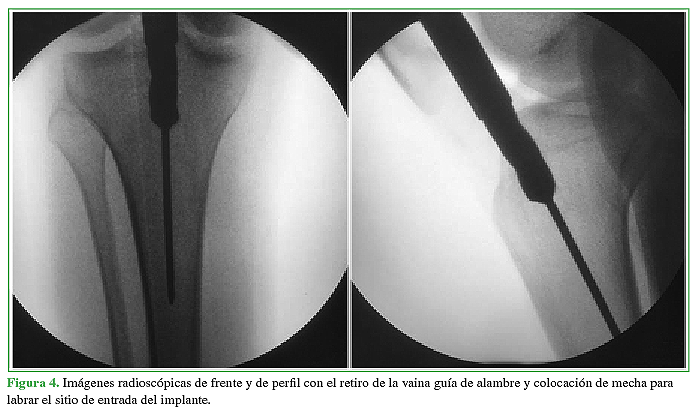 Imágenes radioscópicas de frente y de perfil con el retiro de la vaina guía de alambre y colocación de mecha para labrar el sitio de entrada del implante.