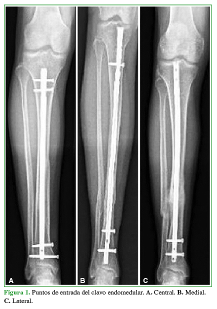Puntos de entrada del clavo endomedular. A. Central. B. Medial. C. Lateral.