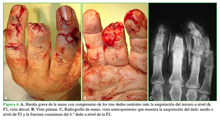 A. Herida grave de la mano con compromiso de los tres dedos centrales más la amputación del tercero a nivel de la F2, vista dorsal. B. Vista palmar. C. Radiografía de mano, vista anteroposterior que muestra la amputación del dedo medio a nivel de F2 y la fractura conminuta del 4.° dedo a nivel de la F2. 