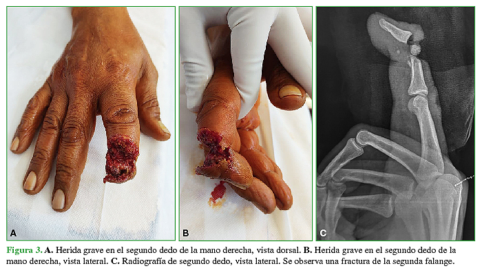 A. Herida grave en el segundo dedo de la mano derecha, vista dorsal. B. Herida grave en el segundo dedo de la mano derecha, vista lateral. C. Radiografía de segundo dedo, vista lateral. Se observa una fractura de la segunda falange. 