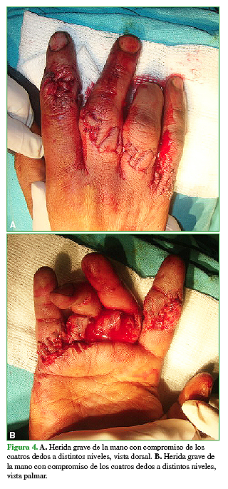 A. Herida grave de la mano con compromiso de los cuatro dedos a distintos niveles, vista dorsal. B. Herida grave de la mano con compromiso de los cuatro dedos a distintos niveles, vista palmar.