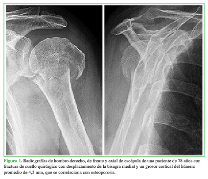Radiografías de hombro derecho, de frente y axial de escápula de una paciente de 78 años con fractura de cuello quirúrgico con desplazamiento de la bisagra medial y un grosor cortical del húmero promedio de 4,3 mm, que se correlaciona con osteoporosis. 