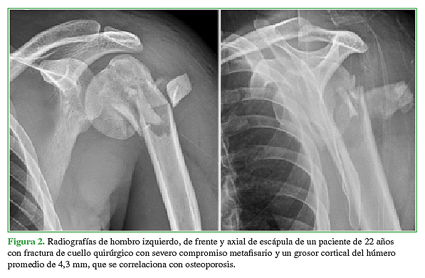 Radiografías de hombro izquierdo, de frente y axial de escápula de un paciente de 22 años con fractura de cuello quirúrgico con severo compromiso metafisario y un grosor cortical del húmero promedio de 4,3 mm, que se correlaciona con osteoporosis. 