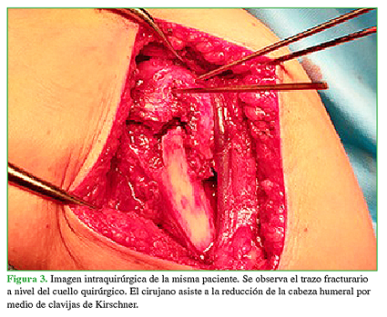 Imagen intraquirúrgica de la misma paciente. Se observa el trazo fracturario a nivel del cuello quirúrgico. El cirujano asiste a la reducción de la cabeza humeral por medio de  clavijas de Kirschner.