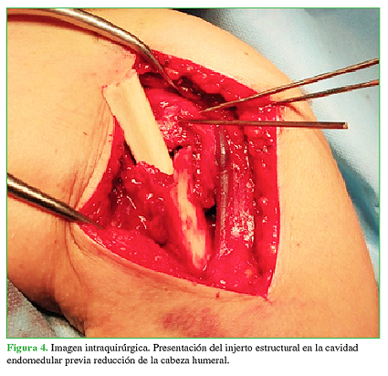 Imagen intraquirúrgica. Presentación del injerto estructural en la cavidad endomedular previa reducción de la cabeza humeral.
