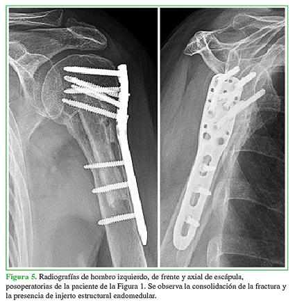 Radiografías de hombro izquierdo, de frente y axial de escápula, posoperatorias de la paciente de la Figura 1. Se observa la consolidación de la fractura y la presencia de injerto estructural endomedular. 