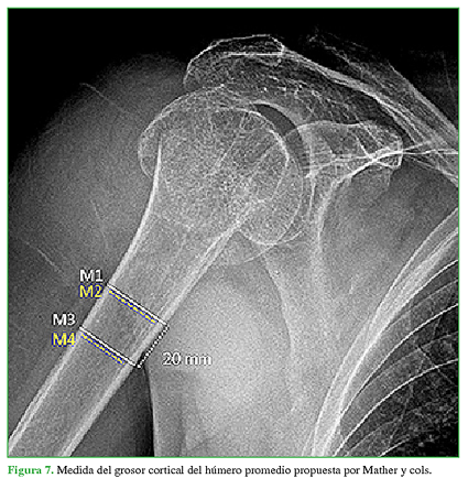 Medida del grosor cortical del húmero promedio propuesta por Mather y cols.