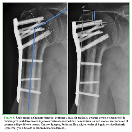 Radiografías de hombro derecho, de frente y axial de escápula, después de una osteosíntesis de húmero proximal derecho con injerto estructural endomedular. Se muestran las mediciones, realizadas en el programa disponible en nuestro Centro (Synapse, Fujifilm). En azul, se resalta el ángulo cervicodiafisario (izquierda) y la altura de la cabeza humeral (derecha). 