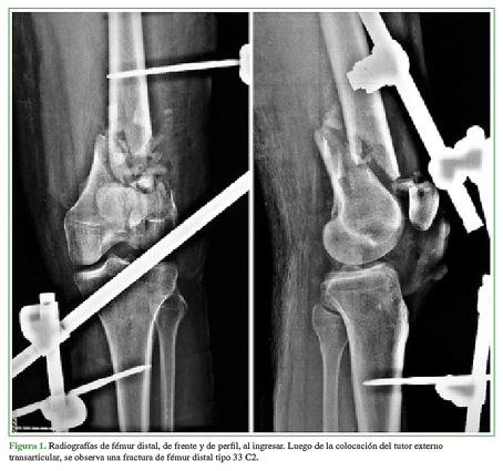 Radiografías de fémur distal, de frente y de perfil, al ingresar. Luego de la colocación del tutor externo transarticular, se observa una fractura de fémur distal tipo 33 C2.