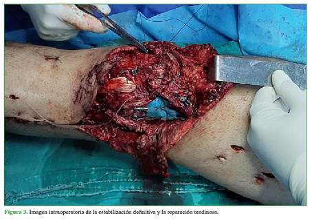 Imagen intraoperatoria de la estabilización definitiva y la reparación tendinosa.
