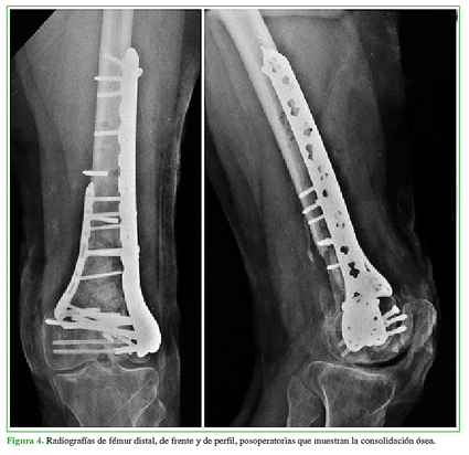 Radiografías de fémur distal, de frente y de perfil, posoperatorias que muestran la consolidación ósea