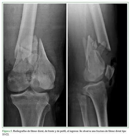 Radiografías de fémur distal, de frente y de perfil, al ingresar. Se observa una fractura de fémur distal tipo 33 C2.
