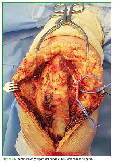 Identificación y reparo del nervio cubital con bandas de goma. 