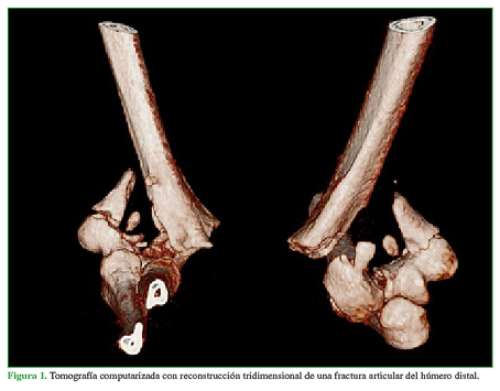 Tomografía computarizada con reconstrucción tridimensional de una fractura articular del húmero distal.
