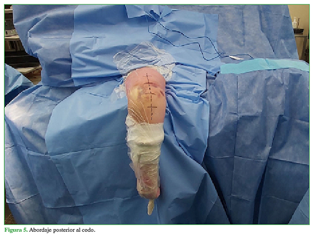 Abordaje posterior al codo.