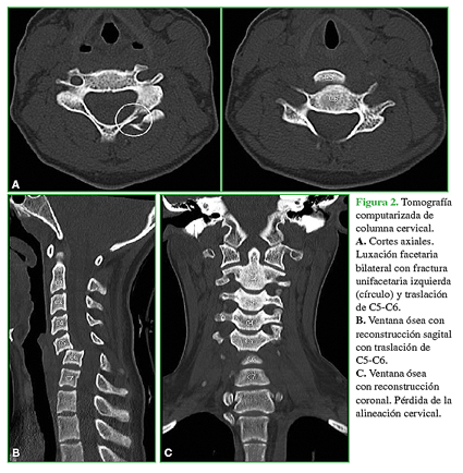 Tomograf&iacute;a computarizada de columna cervical. A. Cortes axiales. Luxaci&oacute;n facetaria bilateral con fractura unifacetaria izquierda (c&iacute;rculo) y traslaci&oacute;n de C5-C6. B. Ventana &oacute;sea con reconstrucci&oacute;n sagital con traslaci&oacute;n de C5-C6. C. Ventana &oacute;sea con reconstrucci&oacute;n coronal. P&eacute;rdida de alineaci&oacute;n cervical. 