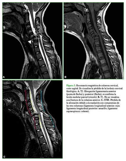 Resonancia magn&eacute;tica de columna cervical, corte sagital. Se visualiza la p&eacute;rdida de la lordosis cervical fisiol&oacute;gica. A. T2. Elongaci&oacute;n ligamentaria anterior (punta de flecha) y posterior (flecha), se confirma la lesi&oacute;n medular parcial (c&iacute;rculo). B. T1. No se visualiza una fractura de la columna anterior. C. STIR. P&eacute;rdida de la alineaci&oacute;n debido a la traslaci&oacute;n con compromiso de las tres columnas (ligamento longitudinal anterior: rojo; ligamento longitudinal posterior: amarillo; ligamento supraespinoso: celeste). 