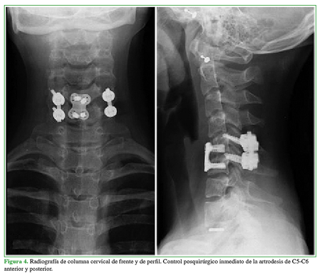 Radiograf&iacute;a de columna cervical de frente y de perfil. Control posquir&uacute;rgico inmediato de la artrodesis de C5-C6 anterior y posterior. 
