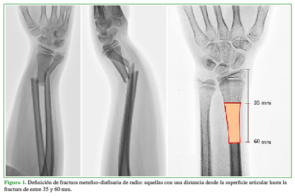 Definición de fractura metafiso-diafisaria de radio: aquellas con una distancia desde la superficie articular hasta la fractura de entre 35 y 60 mm. 