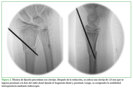 Técnica de fijación percutánea con clavijas. Después de la reducción, se coloca una clavija de 1,8 mm que se ingresa proximal a la fisis del radio distal fijando el fragmento distal y proximal. Luego, se comprueba la estabilidad intraoperatoria mediante radioscopia 